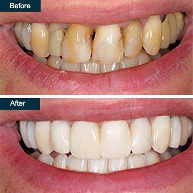 Dental treatment before and after result 6